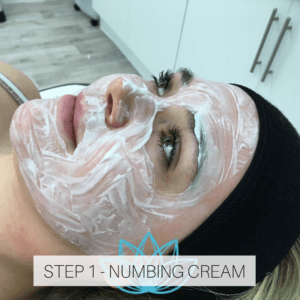 microneedling numbing cream