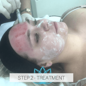 microneedling treatment