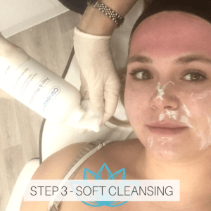 microneedling treatment