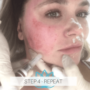 microneedling treatment