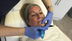 microneedling-discreet-treatment